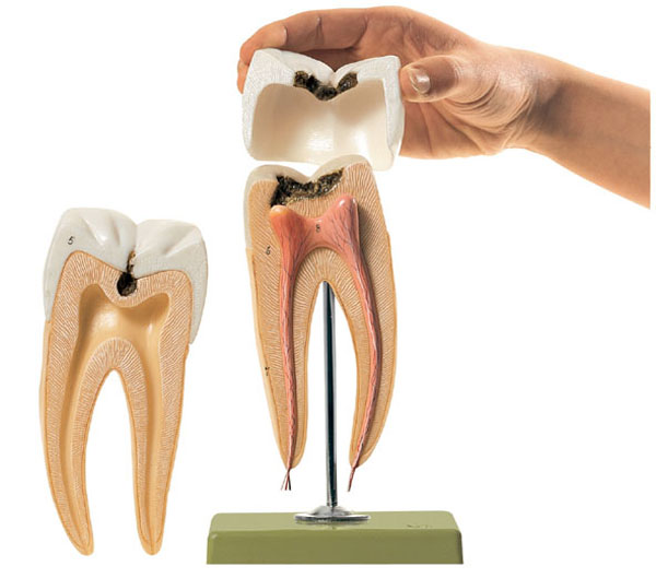 Modèle : molaire avec caries